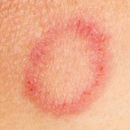 About Ringworm - We Cure Ringworm By Naturopathy Treatment