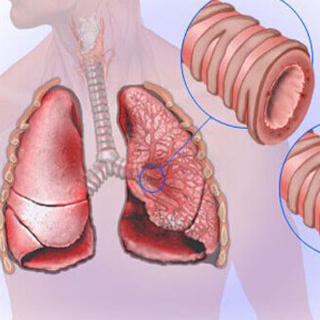 Cure Health Cure Bronchitis By Naturopathy Treatment