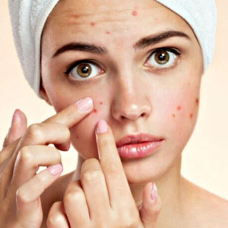 Cure Health Cure Acne-Pimples By Naturopathy Treatment
