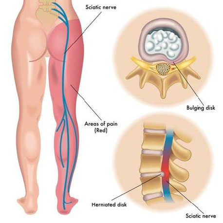 Cure Health Cure Sciatica By Naturopathy Treatment