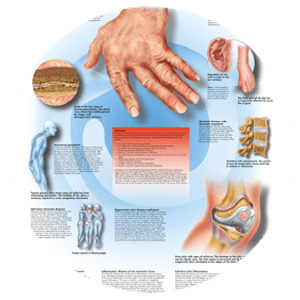 Cure Healths Provide Best And Very Effective Rheumatic Complaints Services To Cure Your Health Problem